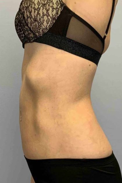 VASER Liposelection Before & After Patient #10407