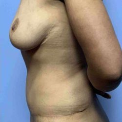 VASER Liposelection Before & After Patient #10568