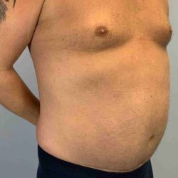 VASER Liposelection Before & After Patient #10575