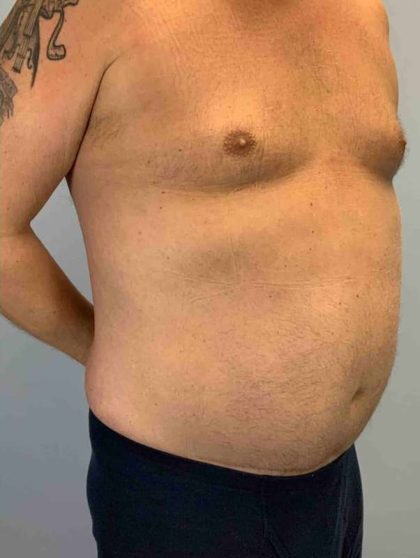 VASER Liposelection Before & After Patient #10575