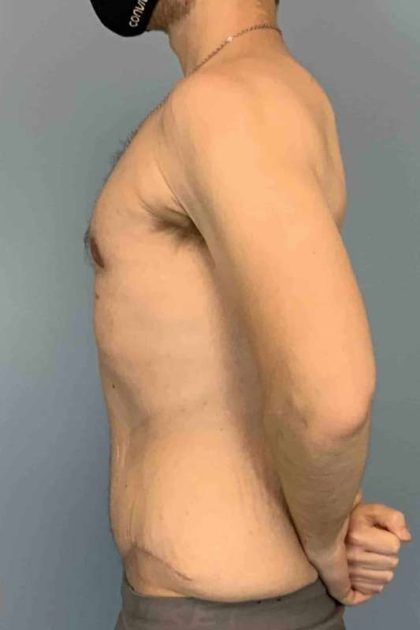 VASER Liposelection Before & After Patient #10602