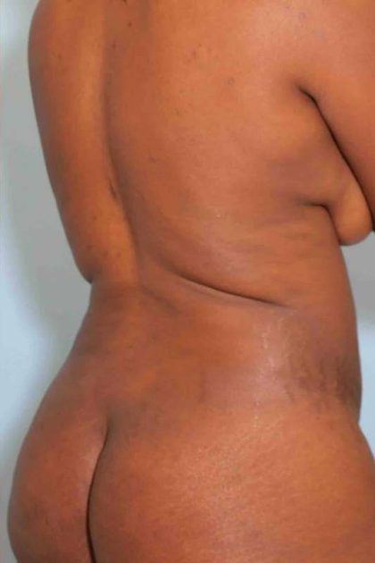 VASER Liposelection Before & After Patient #10631