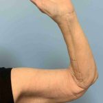 VASER Liposelection Before & After Patient #10652