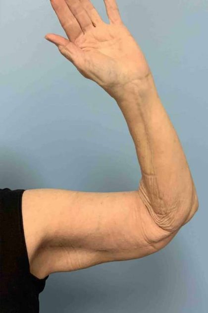 VASER Liposelection Before & After Patient #10652