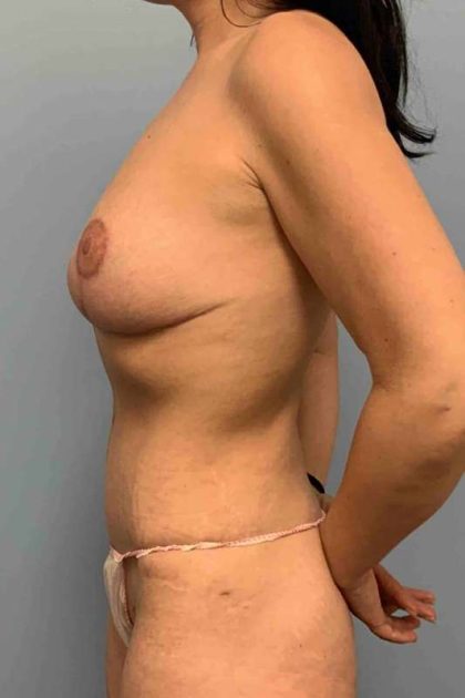 VASER Liposelection Before & After Patient #10661