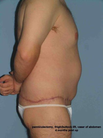 VASER Liposelection Before & After Patient #10400