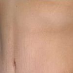 Tummy Tuck Before & After Patient #10689