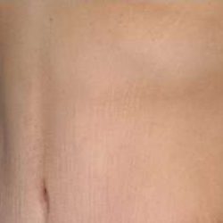 Tummy Tuck Before & After Patient #10689