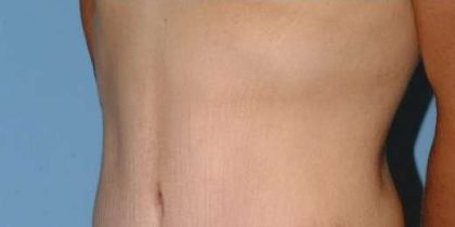 Tummy Tuck Before & After Patient #10689