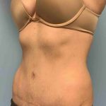 Tummy Tuck Before & After Patient #10721