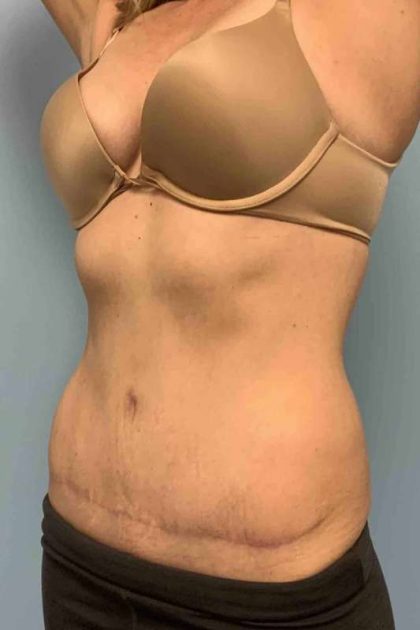 Tummy Tuck Before & After Patient #10721