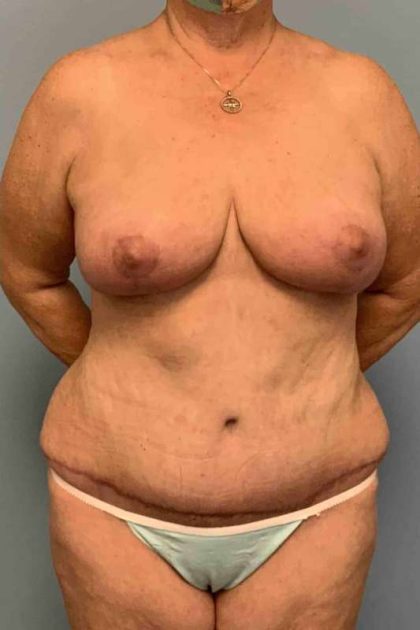 Tummy Tuck Before & After Patient #10728