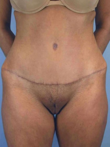 Tummy Tuck Before & After Patient #10742
