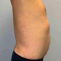 Tummy Tuck Before & After Patient #10749