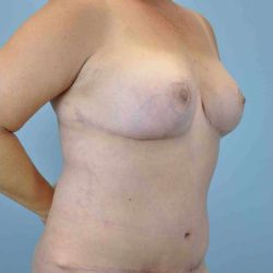 Tummy Tuck Before & After Patient #10765