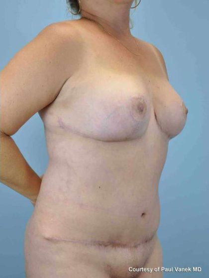 Tummy Tuck Before & After Patient #10765