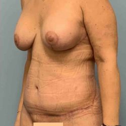 Tummy Tuck Before & After Patient #10786