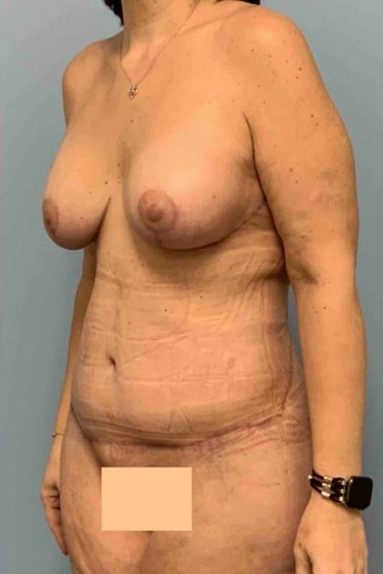 Tummy Tuck Before & After Patient #10786