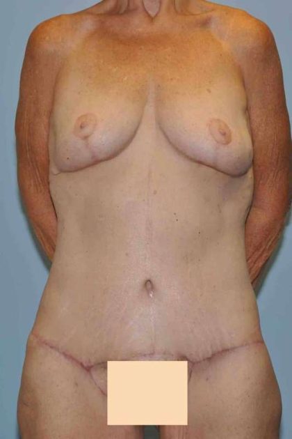 Tummy Tuck Before & After Patient #10793