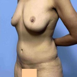 Tummy Tuck Before & After Patient #10800