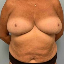 VASER Liposelection Before & After Patient #10466