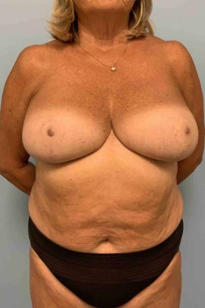 VASER Liposelection Before & After Patient #10466