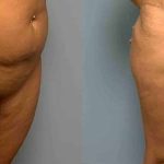 VASER Liposelection Before & After Patient #10479