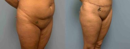 VASER Liposelection Before & After Patient #10479
