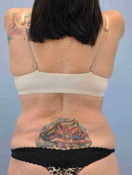 VASER Liposelection Before & After Patient #10511