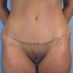 VASER Liposelection Before & After Patient #10543