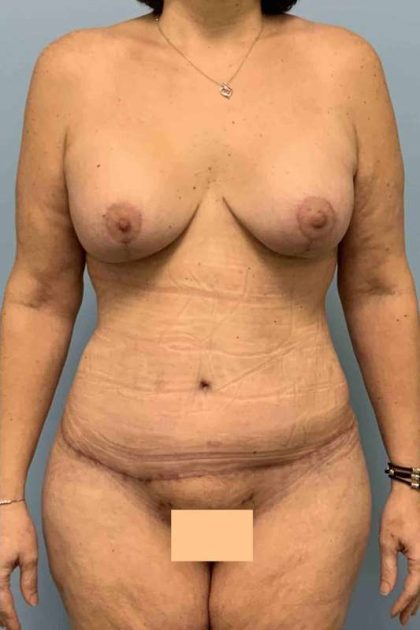 VASER Liposelection Before & After Patient #10561