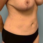VASER Liposelection Before & After Patient #10584