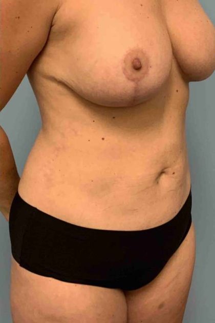 VASER Liposelection Before & After Patient #10584