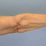 VASER Liposelection Before & After Patient #10615