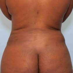 VASER Liposelection Before & After Patient #10631