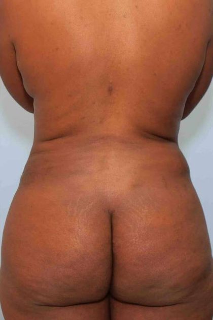 VASER Liposelection Before & After Patient #10631