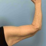 VASER Liposelection Before & After Patient #10652