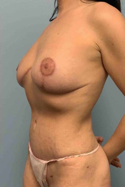VASER Liposelection Before & After Patient #10661