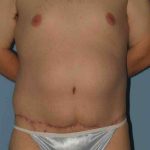 VASER Liposelection Before & After Patient #10400