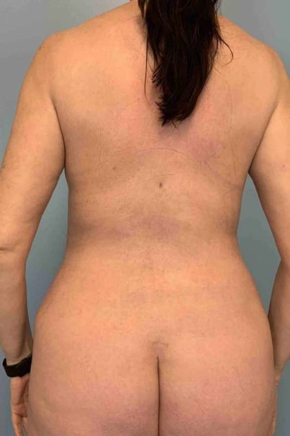 VASER Liposelection Before & After Patient #10670