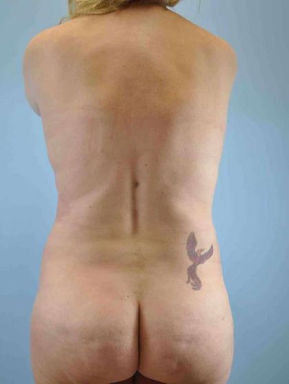 Tummy Tuck Before & After Patient #10714