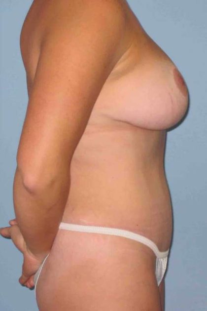 Tummy Tuck Before & After Patient #10758