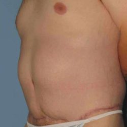 Tummy Tuck Before & After Patient #10774