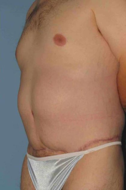 Tummy Tuck Before & After Patient #10774