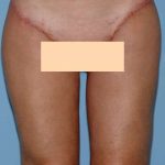 Thigh Surgery Before & After Patient #10890