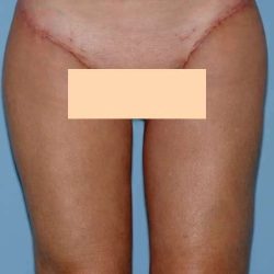 Thigh Surgery Before & After Patient #10890