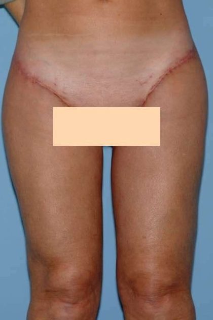 Thigh Surgery Before & After Patient #10890