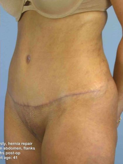 Renuvion Before & After Patient #10960