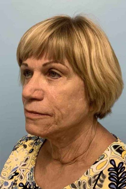 Neck Lift Before & After Patient #11092