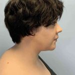 Neck Lift Before & After Patient #11120